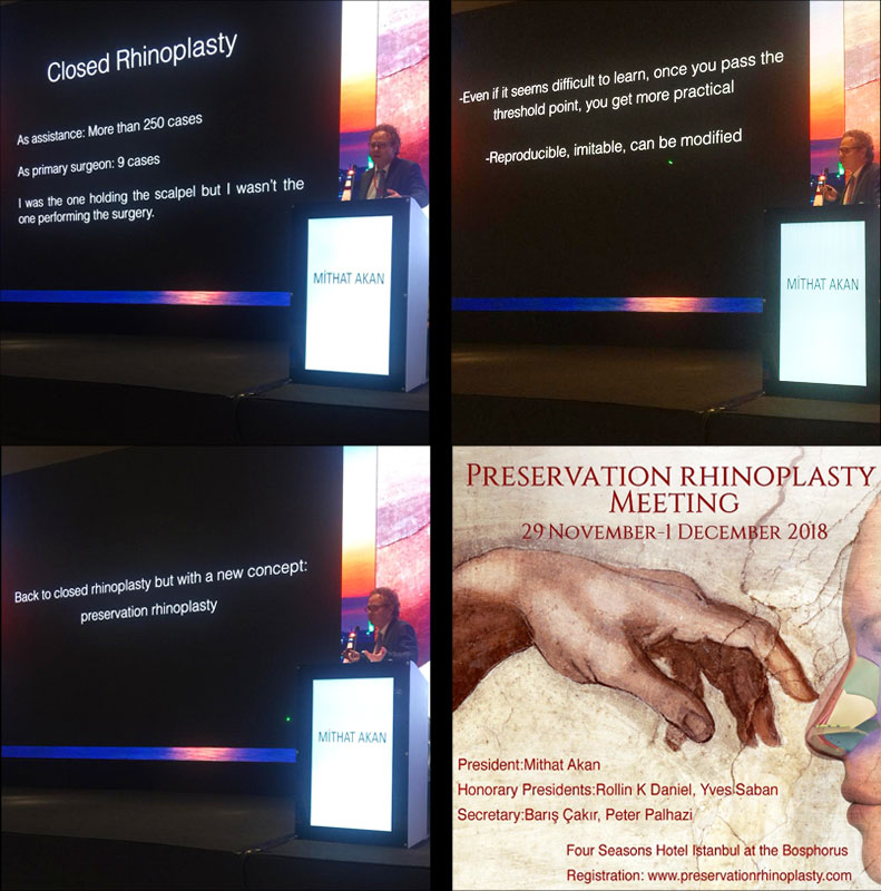 Preservation Rhinoplasty - Koruyucu Rinoplasti 1