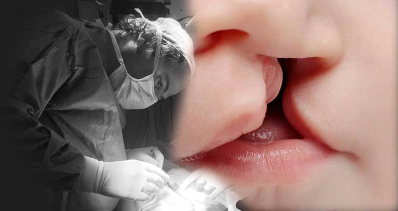 Cleft Lip Nasal Deformity